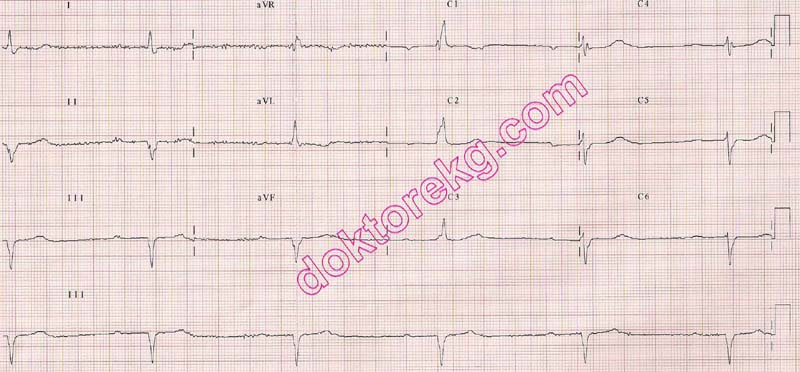 Amiodarone And Electrocardiography Ecg Amiodaron Ekg Ecg