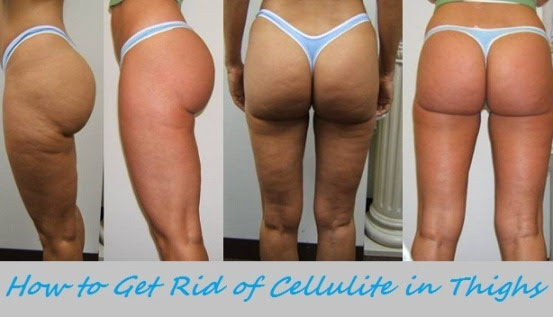 Home Remedies to Get Rid of Cellulite