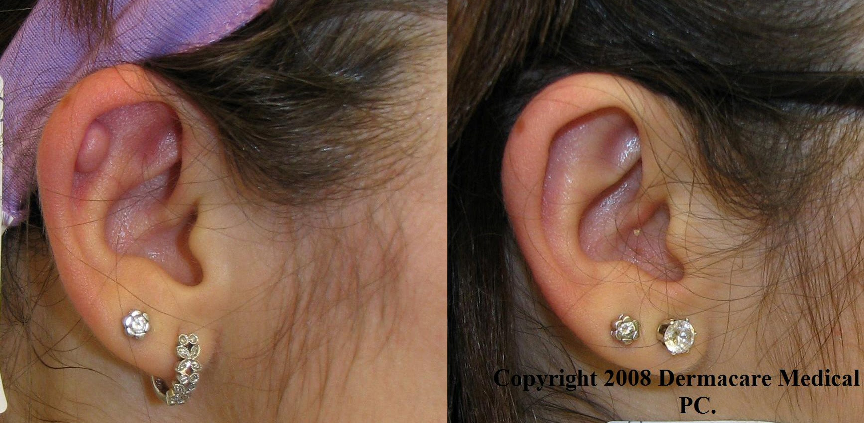 Image Gallery keloid
