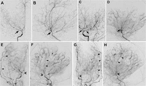 Features include severe intrauterine growth . Surgical outcomes of Majewski osteodysplastic primordial