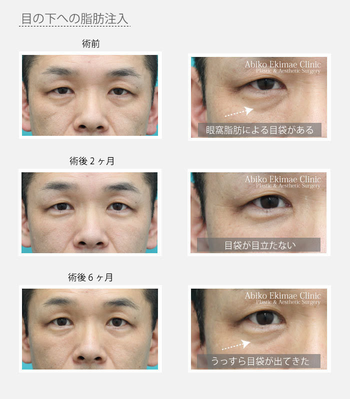目の下の脱脂 経結膜脱脂法 をせずに脂肪注入をするのはどうですか