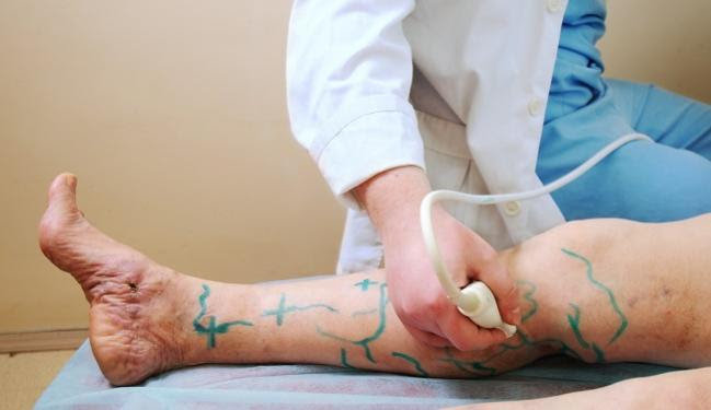 Varicose veins burning feet