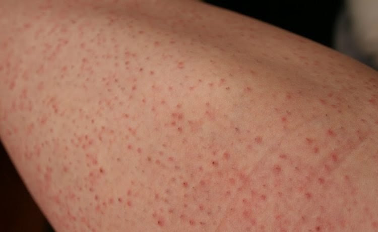 10 tips to prevent ingrown hair | Dermatologist in Thane ...