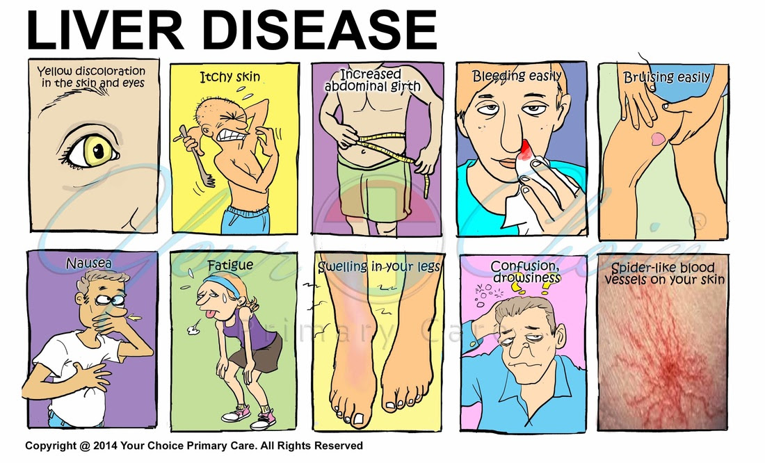 LiverDisease - Your Choice Primary Care (You Choi MD ...