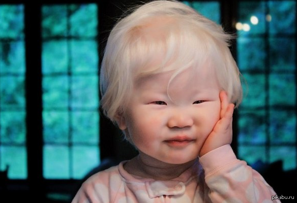 アルビノ日本人赤ちゃんに子供が神秘的で美しいのは本当か えてぃまる 夢みる若者が社会をまるっと知るブログ