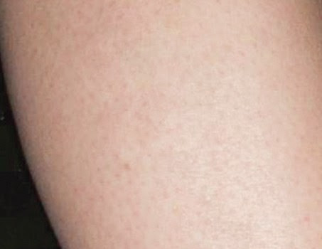 tattoo-removal-1_after