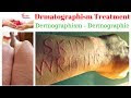 Drmatographism Treatment - Dermographism – Dermographic
