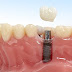 Krone Zahn : Vollkeramikkrone / Zahnkrone / CEREC - Zahnarzt Wien 1090 : Für eine private krone sind im.