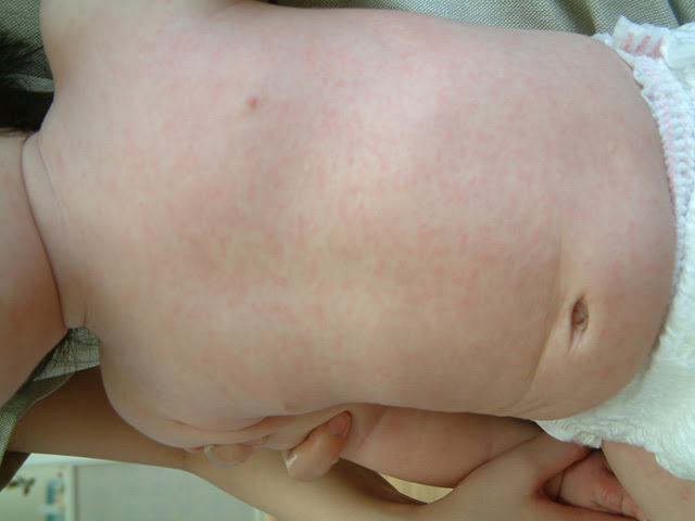 きのした小児科 突発性発疹症