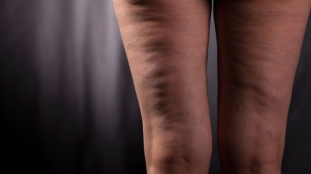 15 Myths and Facts About Cellulite - ABC News