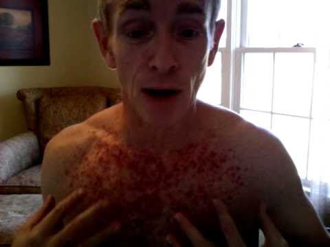 Skin Cancer Cream Fluorouracil - Topical chemo therapeutic treatments for non melanoma skin - Others are subtler and harder to spot.