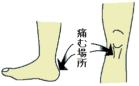 成長期に起こりやすい痛み