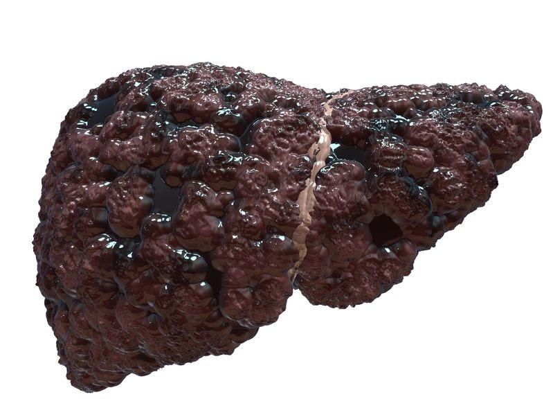 grasa en el hígado cirrosis