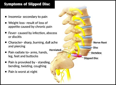 Lelaki Ini Mengaku Boleh Betulkan Slipped Disc Hanya 