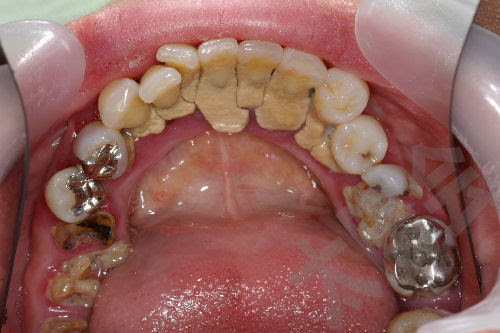 橋本歯科医院 治療内容 歯周病 重度の歯周病