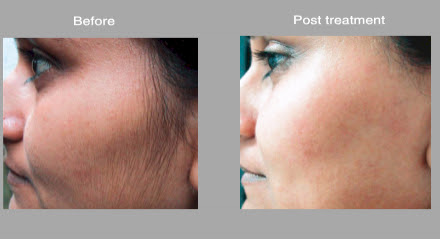High Speed Laser Hair Removal Photos in Tacoma