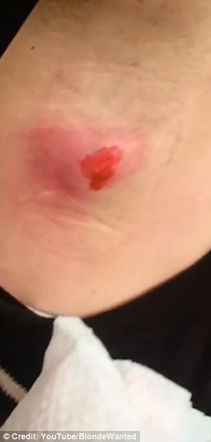 Skin cancer armpit