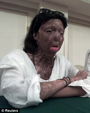 Life-changing: Fakhra Younus, pictured left before the horrific acid attack in May 2000, was left heavily facially disfigured after having acid thrown in her face
