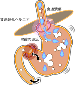 逆流性食道炎の原因と治療 イラストでみる胃疾患 飯原医院 Jp