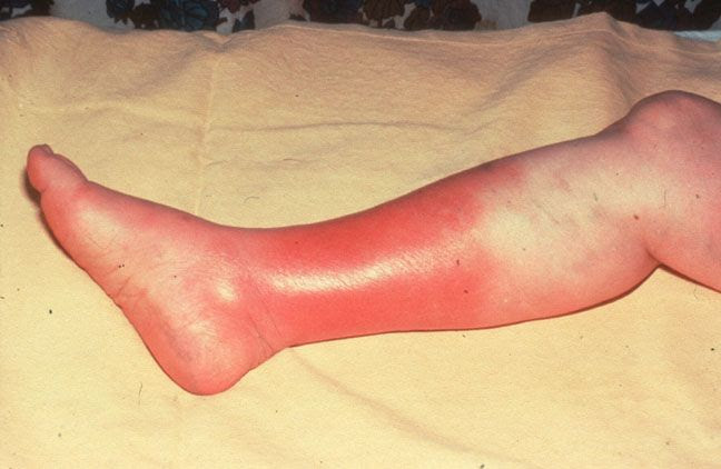 Cellulitis. | Medicine | Pinterest
