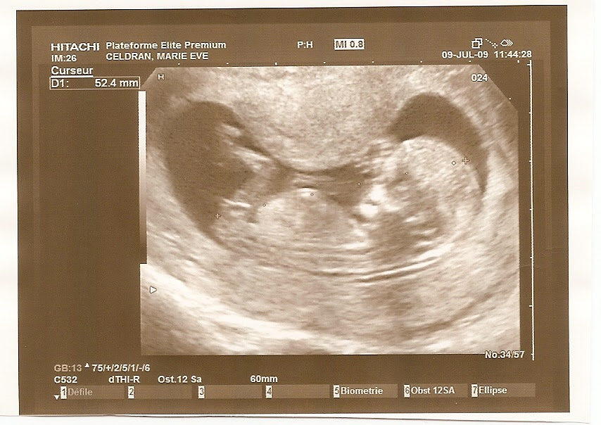Notre Bebe Au Bout De 3 Mois De Grossesse Marieetolivier