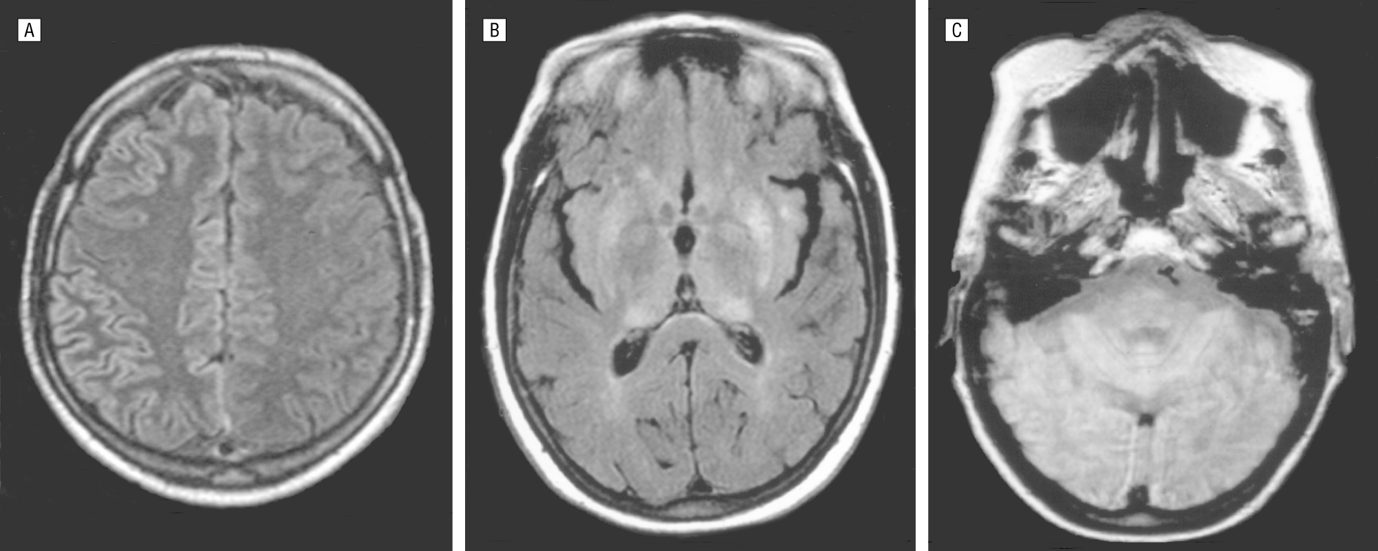 Alzheimeraposs Association Alzheimeraposs Disease Dementia Help