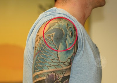 Tattoo Removal Case Studies - Vanishing Ink