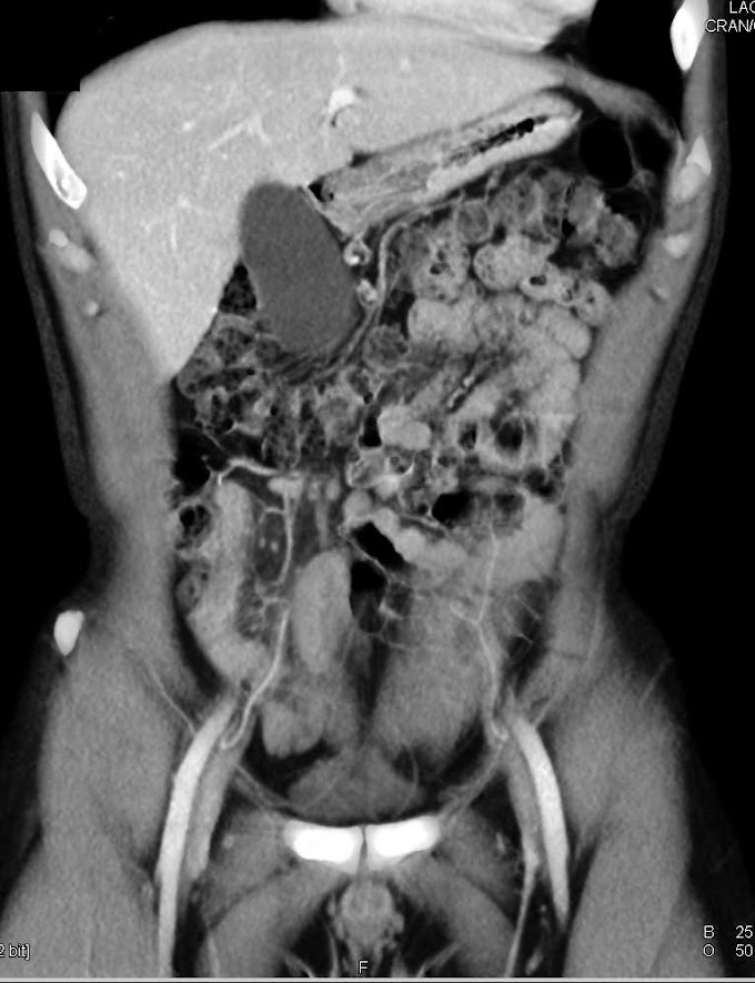 Sigmoid Colon Cancer Ct Scan / Peritoneal carcinomatosis - Radiology at St. Vincent's : See what you need to know about this.