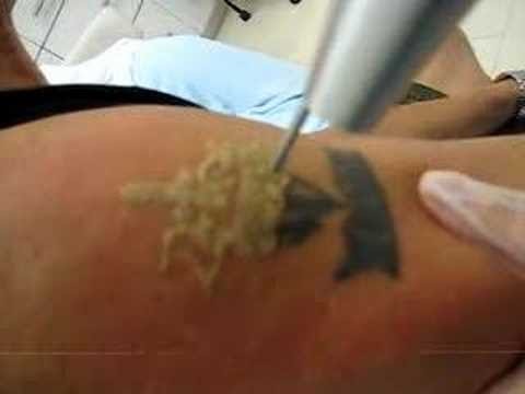 Does Wrecking Balm Tattoo Removal Lotion Work www.medispainstitute.com Laser 