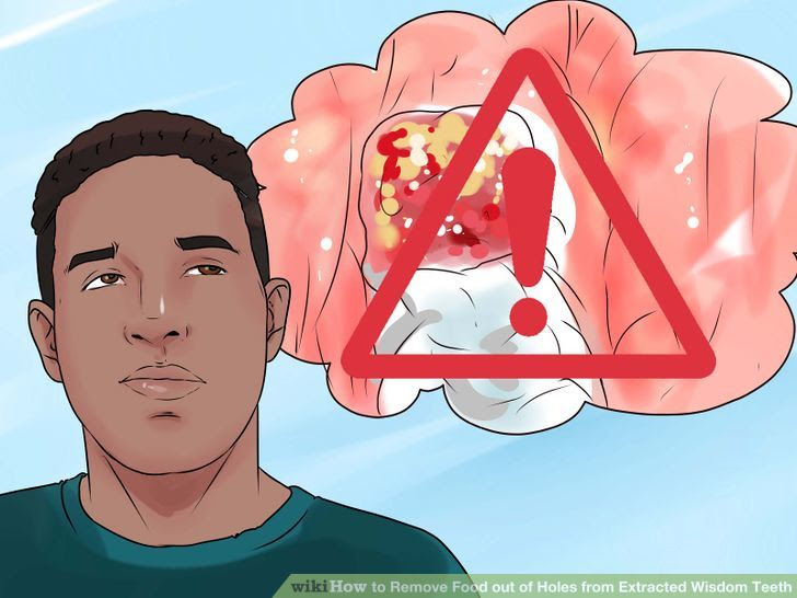 Remove Food out of Holes from Extracted Wisdom Teeth Step 14.jpg