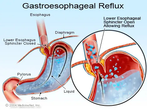 Picture of heartburn and GERD