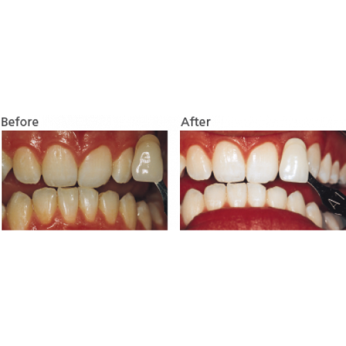 Pola Day 6% Teeth Whitening Bleaching Gel 4 Pack