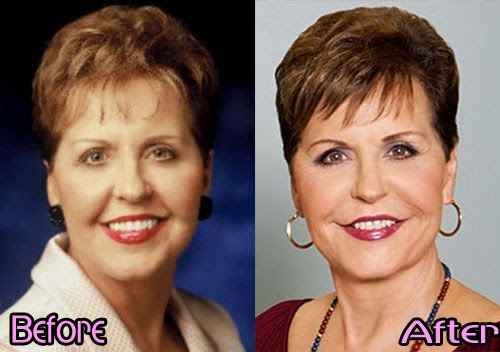 Joyce Meyer plastic surgery before and after photos