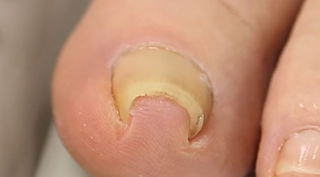 VIDEO: Great Tool For Ingrown Toenail Salvation ...