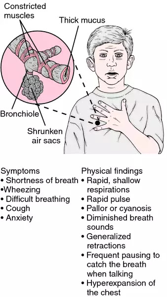 Asthma attack  definition of asthma attack by Medical 
