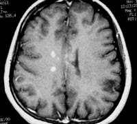 Axial T1-weighted, gadolinium-enhanced MRI in a pa