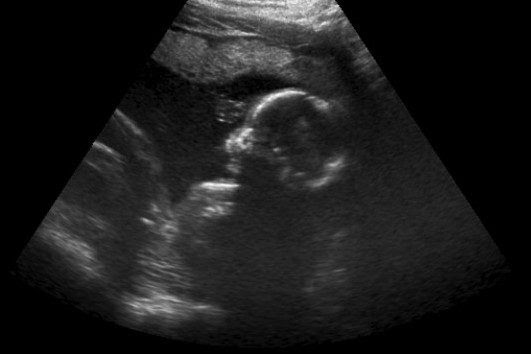 (Ultrasound of a baby in the womb) Dr. Juan Carlos Navarrete Jaimes of the Merida Clinic performed an ultrasound on the 11-year-old girl and found the mother and child to be in excellent health