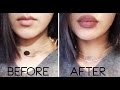 Fuller Lips with Lip Injections : Price and Experience