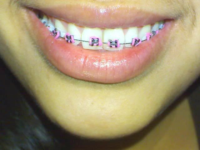 selena gomez teeth. on selena gomez some of