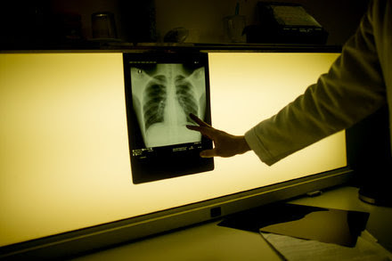 Fast, Cheap Testing for Tuberculosis? Soon It May Be Possible