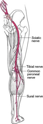 Sciatica