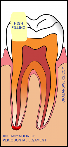 Pain Caused By A High Filling Why It Happens And How To Fix It Oral Answers