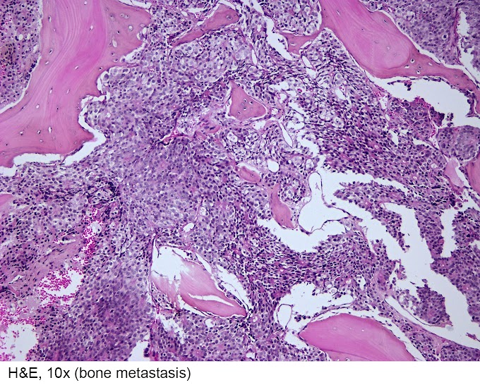 Prostate Cancer Diagnosis Histological / The standards of an ultrasound examination of the prostate : The pancreas is located behind the stomach, so having pancreatic cancer doesn’t involve a palpable mass that you can feel.