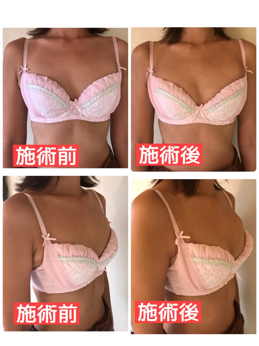 なぜdカップで谷間ができないのか 神楽坂のバストアップ 育乳サロン Heavensdoor