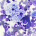 Niemann Pick - Niemann-Pick disease. Causes, symptoms, treatment Niemann ... - It is quite different from most other dementias.