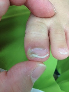 爪囲炎 野田市 小児科 千葉県 こどもの花粉症 こどもの漢方 喘息 アトピー性皮膚炎 アレルギー 結節性痒疹 たんぽぽこどもクリニック