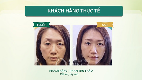 Cắt mí sau bao lâu thì cắt chỉ? Chăm sóc như thế nào cho mắt mau lành?