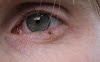 Skin Cancer Freckle / How do I check myself for melanoma? - Melanoma Institute