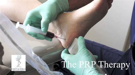 He served as assistant team physician to chivas usa (major league. PRP Platelet Rich Plasma Therapy for Plantar Fasciitis