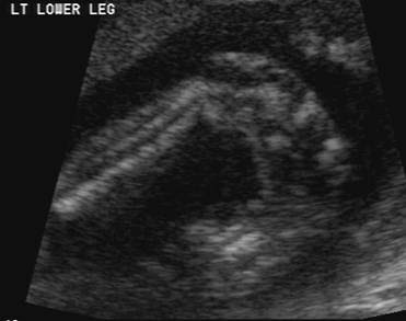 Clubfoot Deformity Talipes Equinovarus